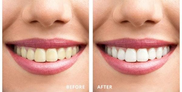 ProDentim teeth whitening supplement